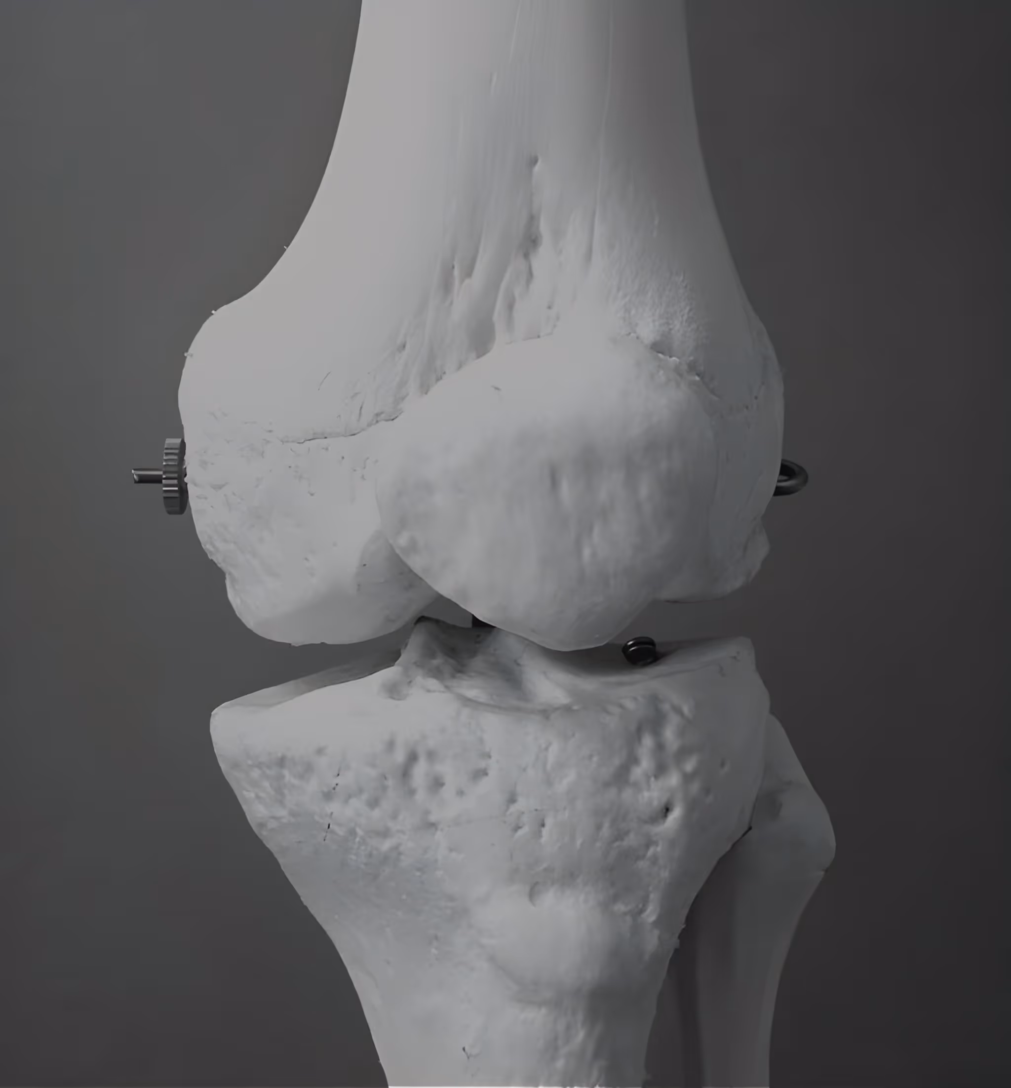 Infiltrazioni Articolari Ginocchio Spalla Anca Per Dolori Tendiniti
Artrosi Brescia