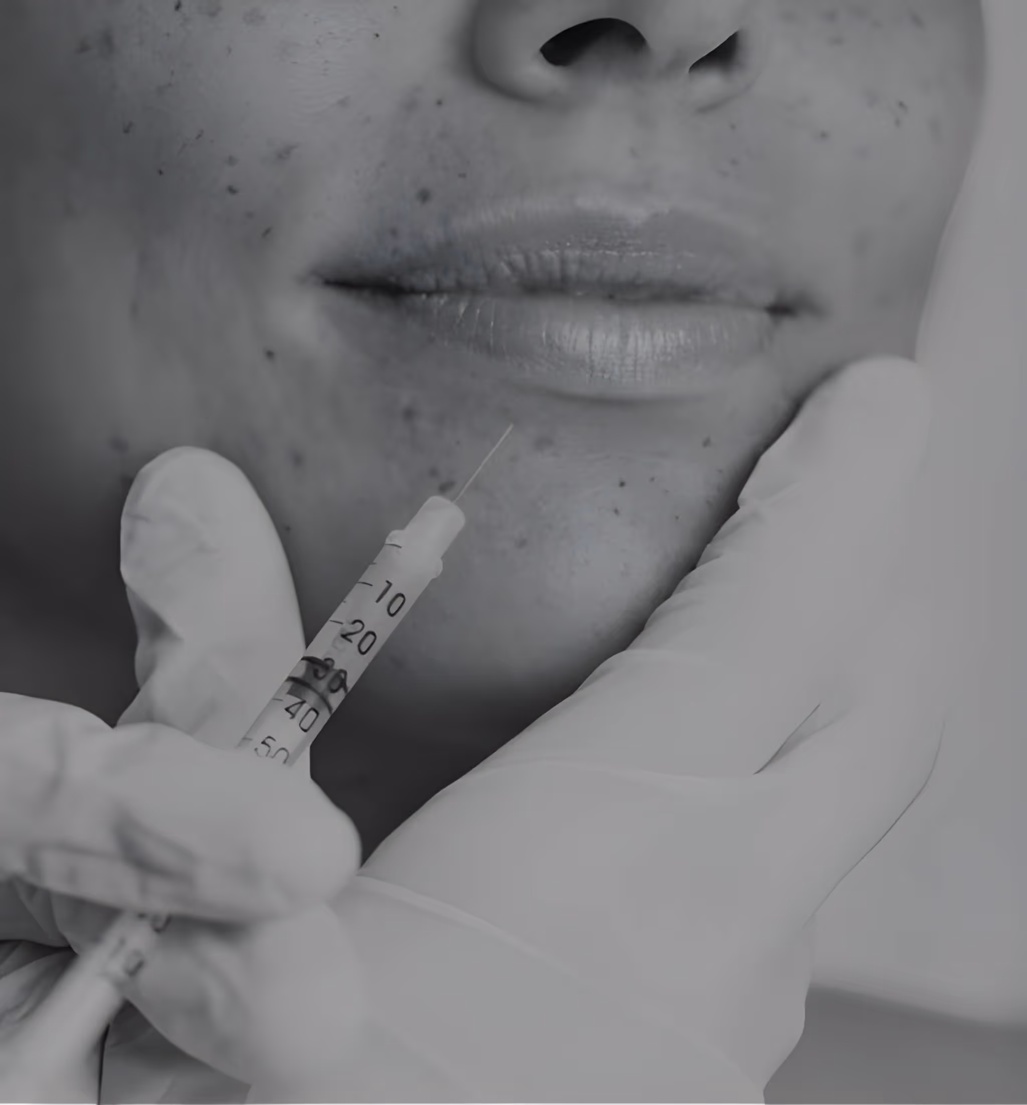 Filler Labbra Zigomi Per Armonizzare Lineamenti Centro Medicina
Estetica Brescia